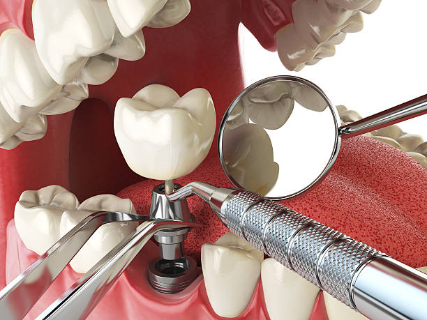 Best Emergency Dental Care for Abscessed Tooth in Tustin, CA
